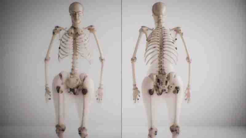 Medical image showing a man's skeleton with several dark spots along the bones - Digital concept art for illustrative purpose, tags: medizinische - Monok